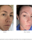 Before and 2 weeks after pictures of participant of 4-week Patient Trials on the Replenix Discoloration regimen