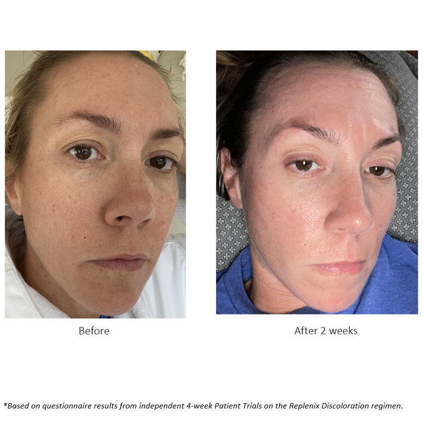 Before and after pictures of 2 weeks into the 4 week Patient Trial on the Replenix Discoloration Regimen