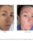 Before and after pictures after use of the 4-week Patient Trials on the Replenix Discoloration regimen