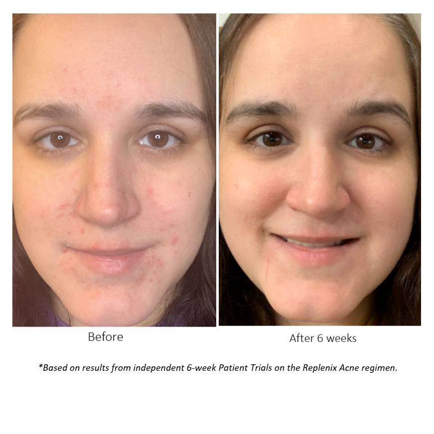 Before and after pictures after 6 weeks of Patient Trials on the REPLENIX Acne Regimen