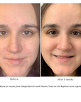 Before and after pictures after 6 weeks of Patient Trials using the REPLENIX Acne Regimen