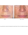 Before and after pictures after 6 weeks of Patient Trials on the Replenix Anti-Aging regimen