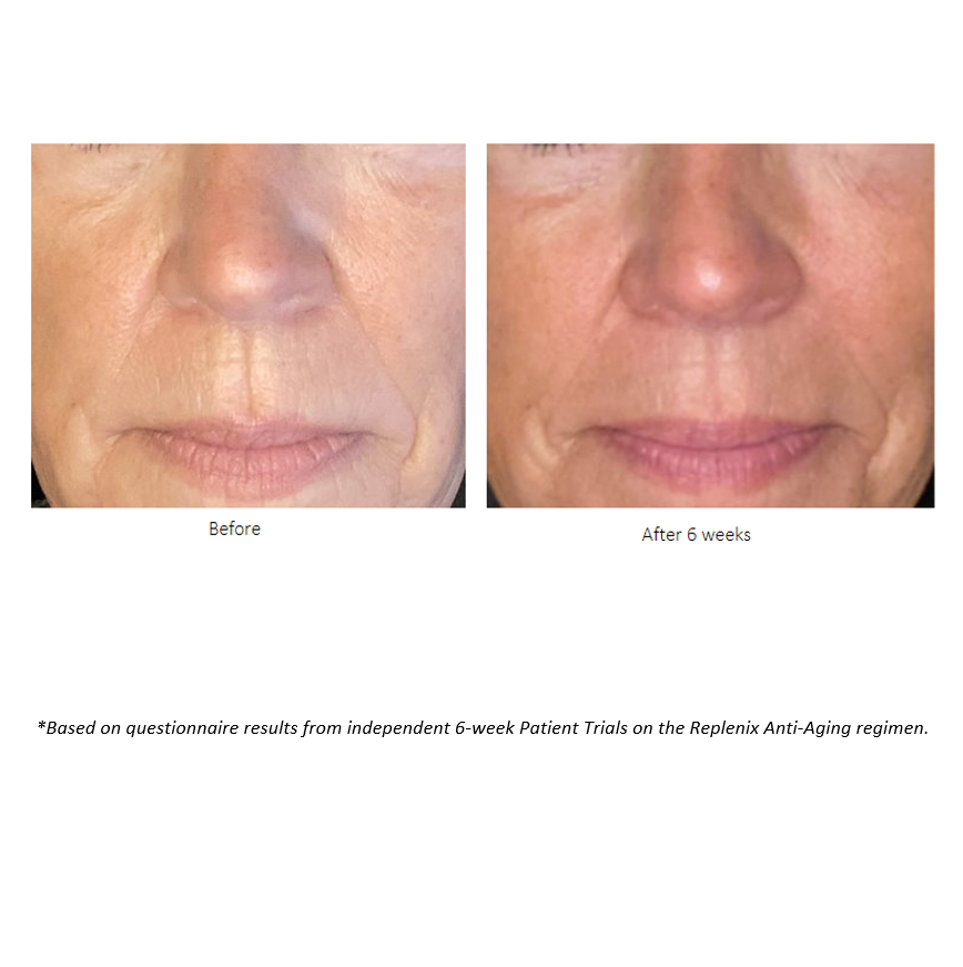 Before and after pictures after 6 weeks of Patient Trials on the Replenix Anti-Aging regimen